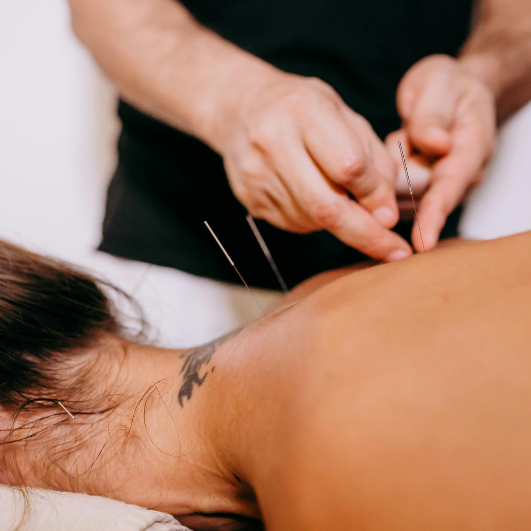 Acupuntura